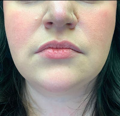 Lip Augmentation Before & After Gallery - Patient 38203948 - Image 1