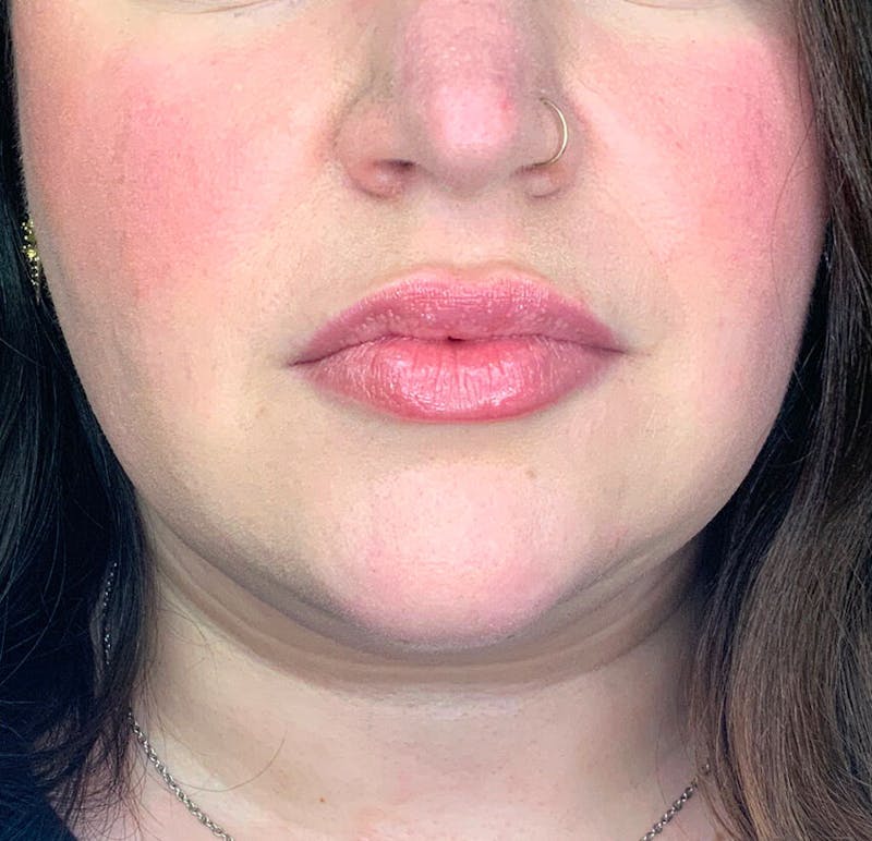Lip Augmentation Before & After Gallery - Patient 38203948 - Image 2