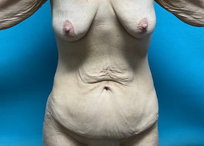Abdominoplasty Before & After Gallery - Patient 463370 - Image 1