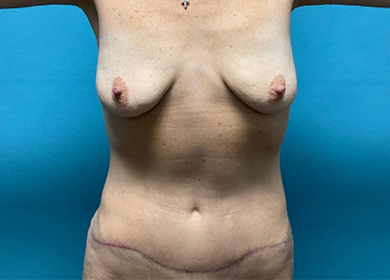 Abdominoplasty Before & After Gallery - Patient 463370 - Image 2