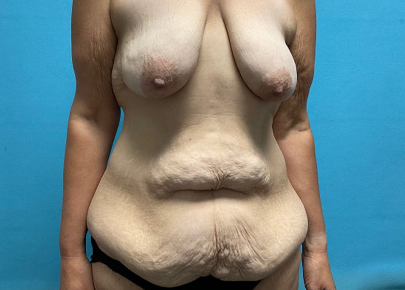 Mastopexy Before & After Gallery - Patient 355232 - Image 1