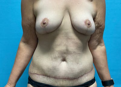 Mastopexy Before & After Gallery - Patient 355232 - Image 2