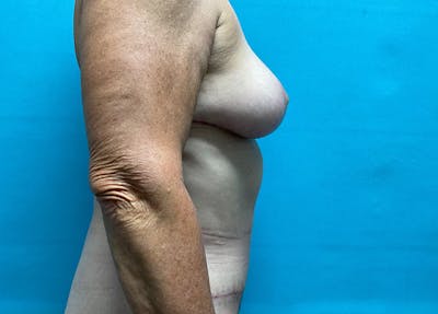 Abdominoplasty Before & After Gallery - Patient 270698 - Image 2
