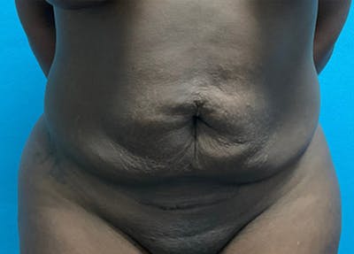Abdominoplasty Before & After Gallery - Patient 453656 - Image 1