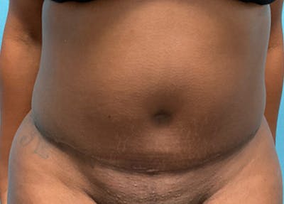 Abdominoplasty Before & After Gallery - Patient 453656 - Image 2