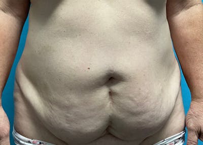Abdominoplasty Before & After Gallery - Patient 100955 - Image 1