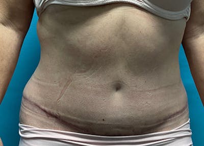 Abdominoplasty Before & After Gallery - Patient 100955 - Image 2