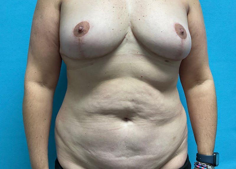 Breast Reduction Before & After Gallery - Patient 289084 - Image 2