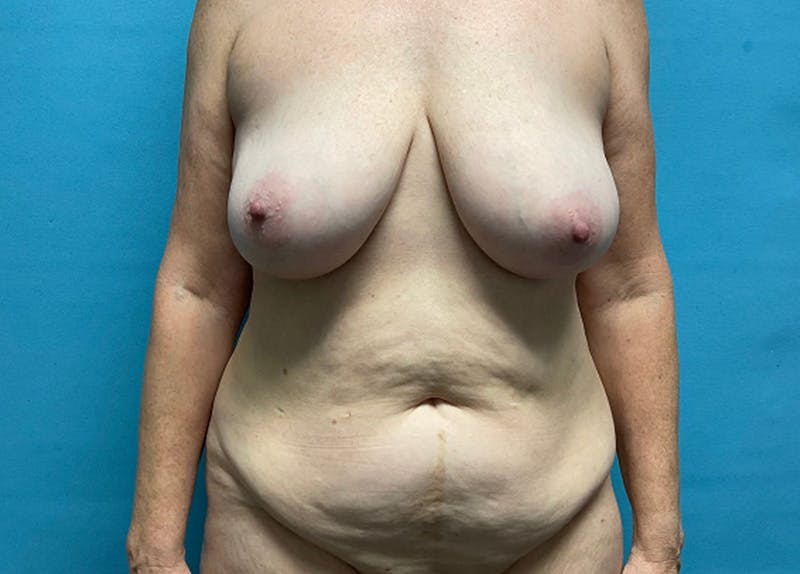 Abdominoplasty Before & After Gallery - Patient 428403 - Image 1