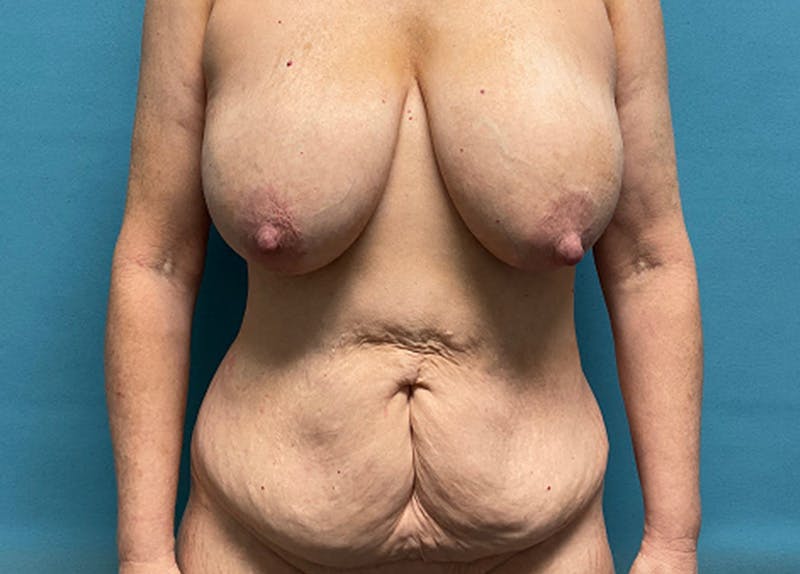 Mastopexy Before & After Gallery - Patient 275218 - Image 1