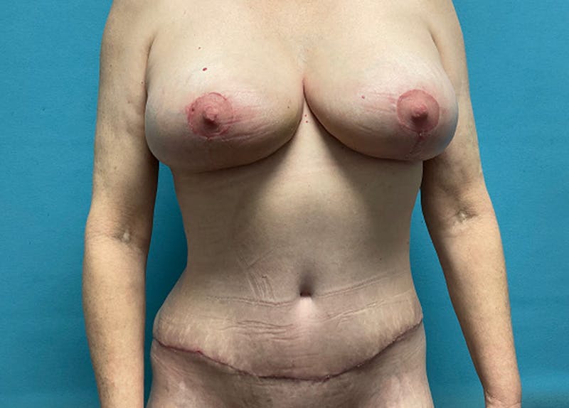 Liposuction Before & After Gallery - Patient 227916 - Image 2