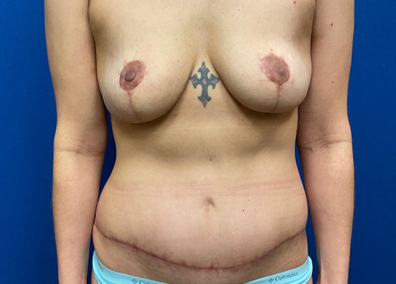 Mastopexy Before & After Gallery - Patient 412022 - Image 2
