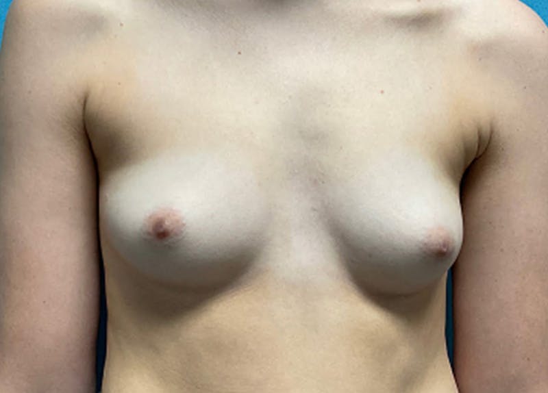 Breast Augmentation Before & After Gallery - Patient 148244 - Image 1
