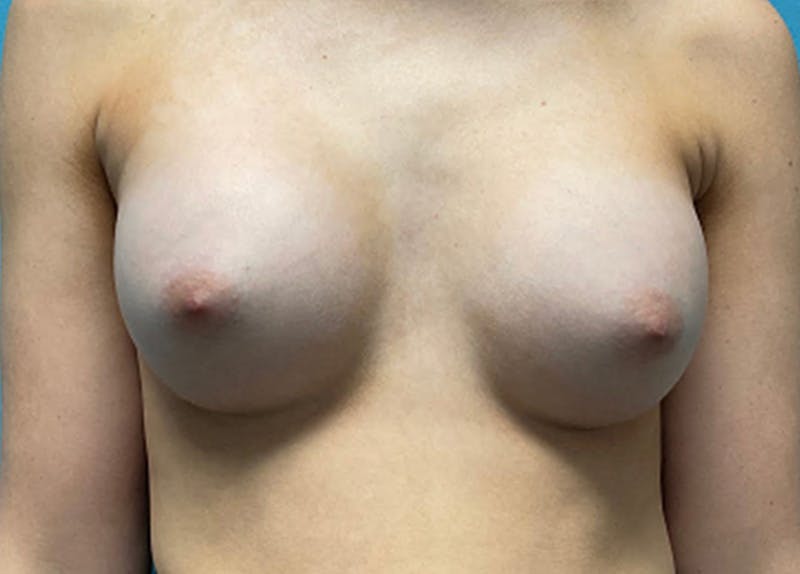 Breast Augmentation Before & After Gallery - Patient 148244 - Image 2