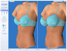 Vectra-3D Procedures