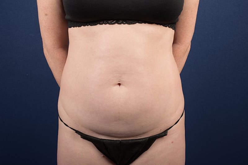 Abdominoplasty Before & After Gallery - Patient 9265396 - Image 1