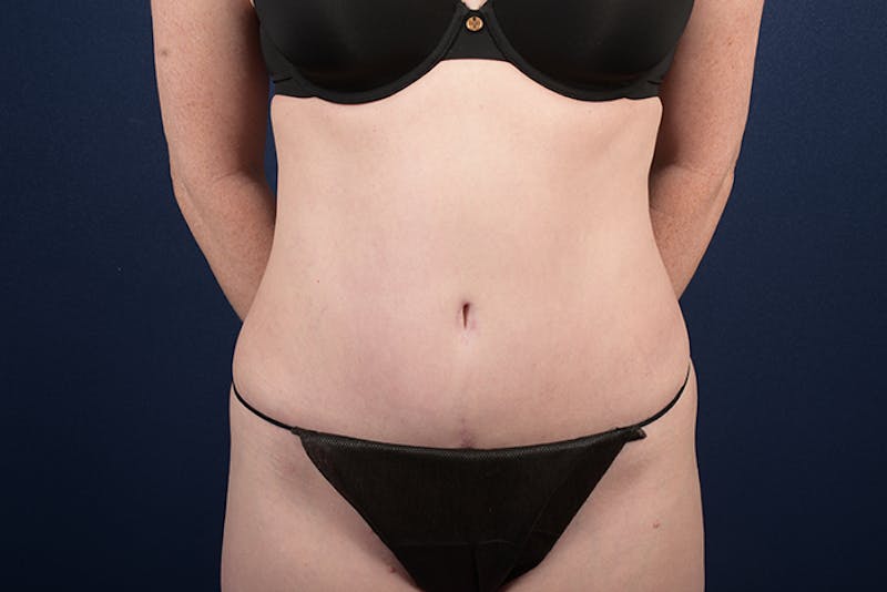Abdominoplasty Before & After Gallery - Patient 9265396 - Image 2