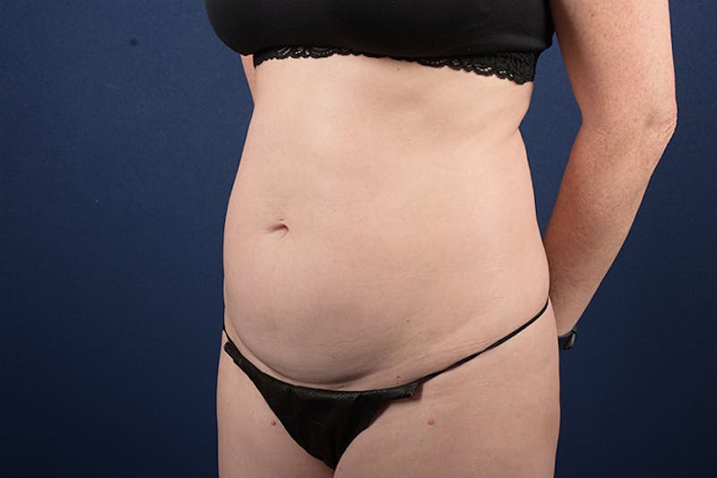 Abdominoplasty Before & After Gallery - Patient 9265396 - Image 3