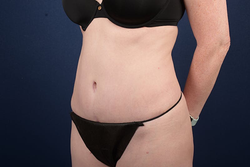 Abdominoplasty Before & After Gallery - Patient 9265396 - Image 4