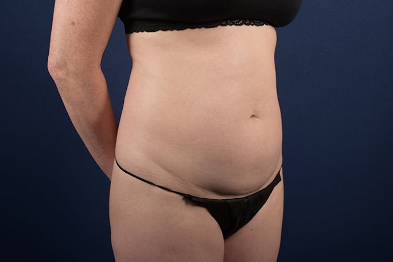 Abdominoplasty Before & After Gallery - Patient 9265396 - Image 5