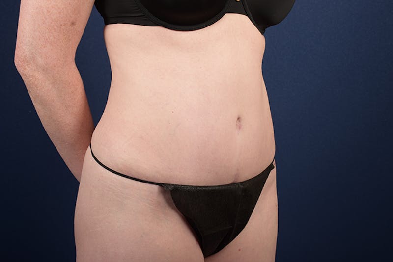 Abdominoplasty Before & After Gallery - Patient 9265396 - Image 6