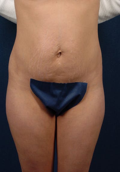 Abdominoplasty Before & After Gallery - Patient 9265410 - Image 1
