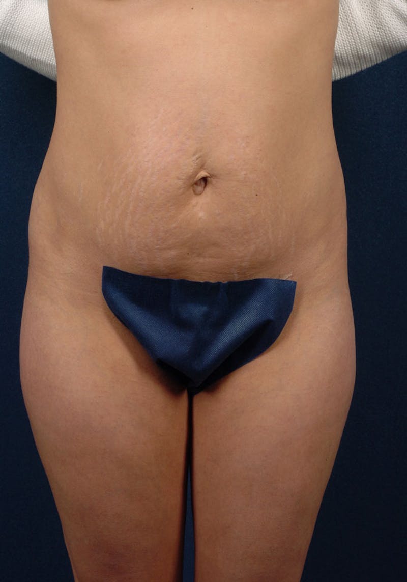Abdominoplasty Before & After Gallery - Patient 9265410 - Image 1