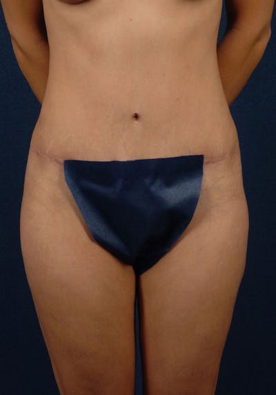 Abdominoplasty Before & After Gallery - Patient 9265410 - Image 2