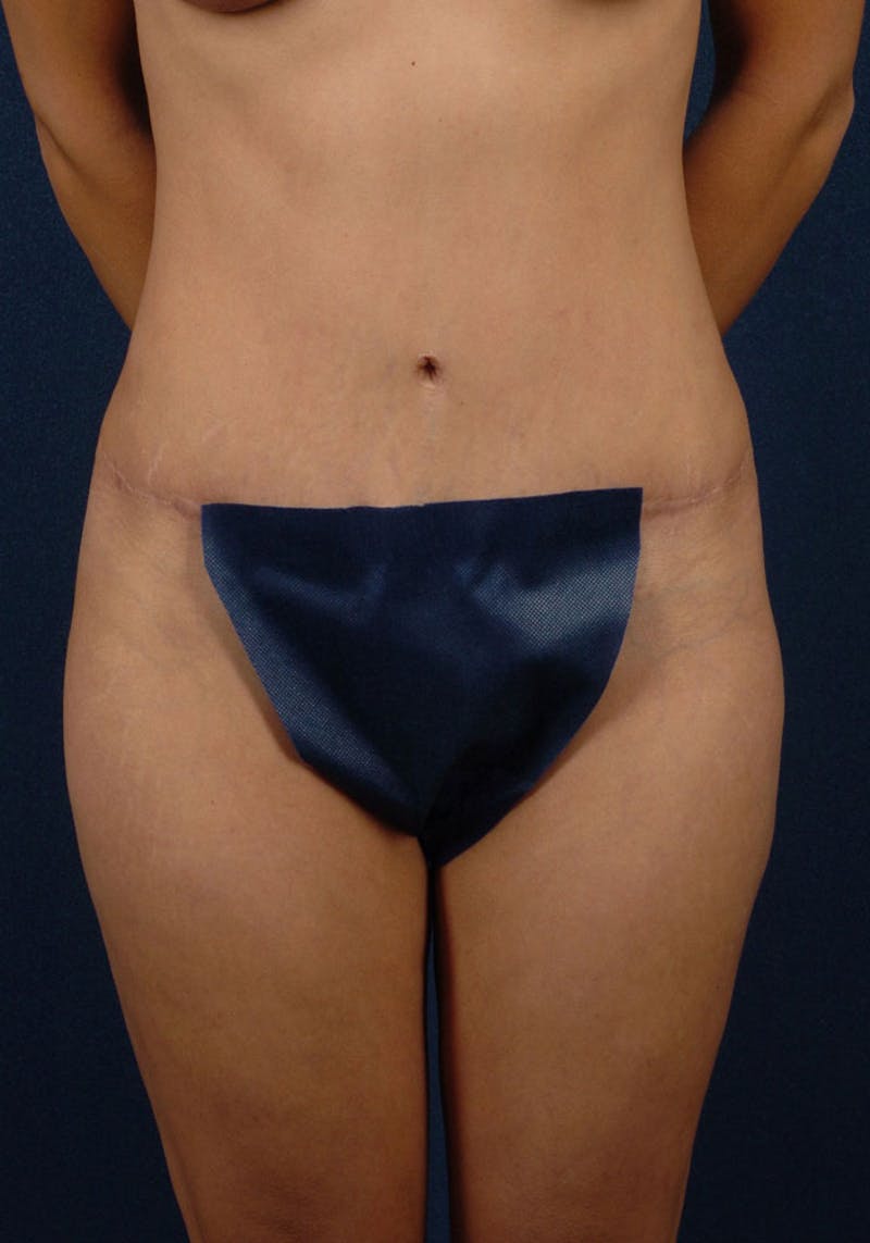 Abdominoplasty Before & After Gallery - Patient 9265410 - Image 2