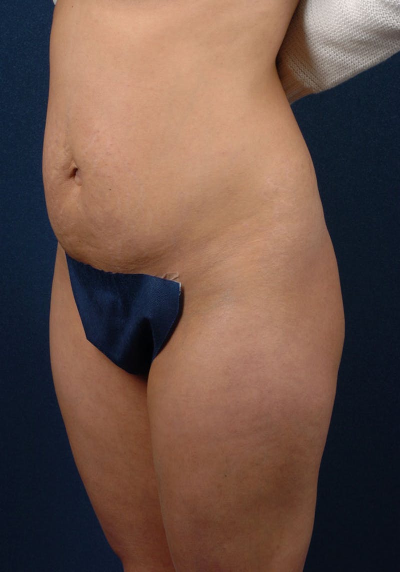 Abdominoplasty Before & After Gallery - Patient 9265410 - Image 3