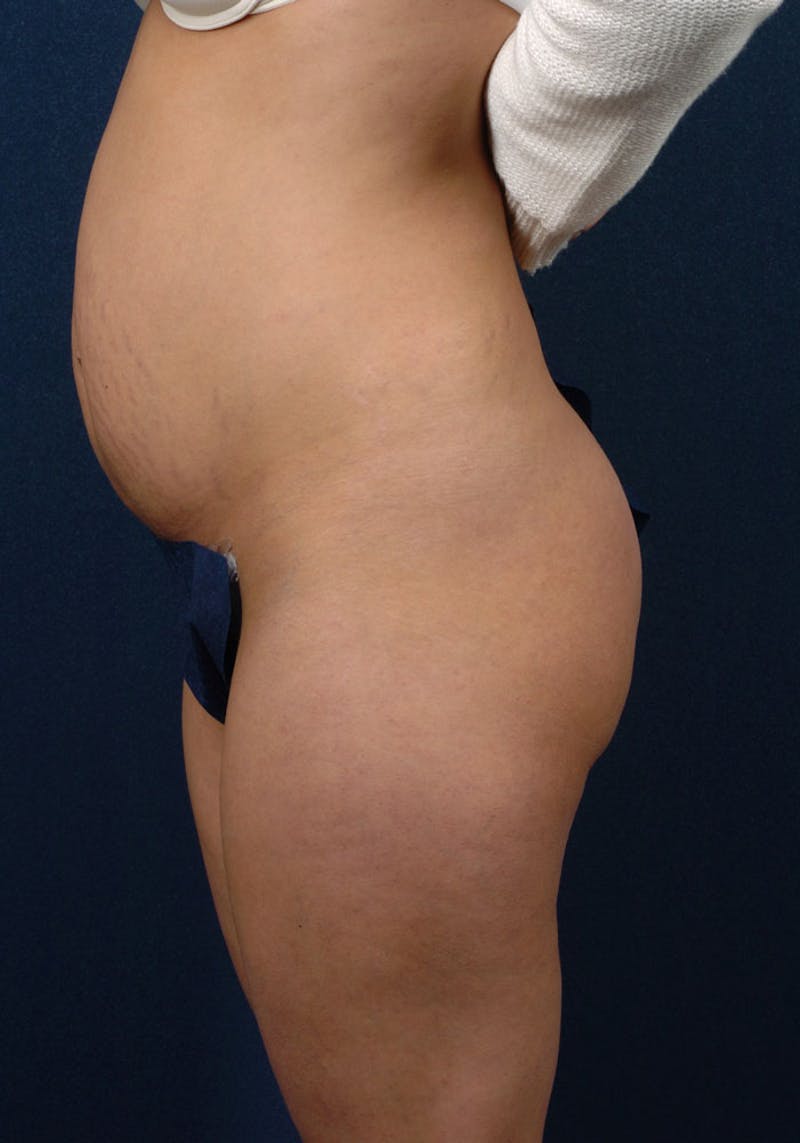 Abdominoplasty Before & After Gallery - Patient 9265410 - Image 5