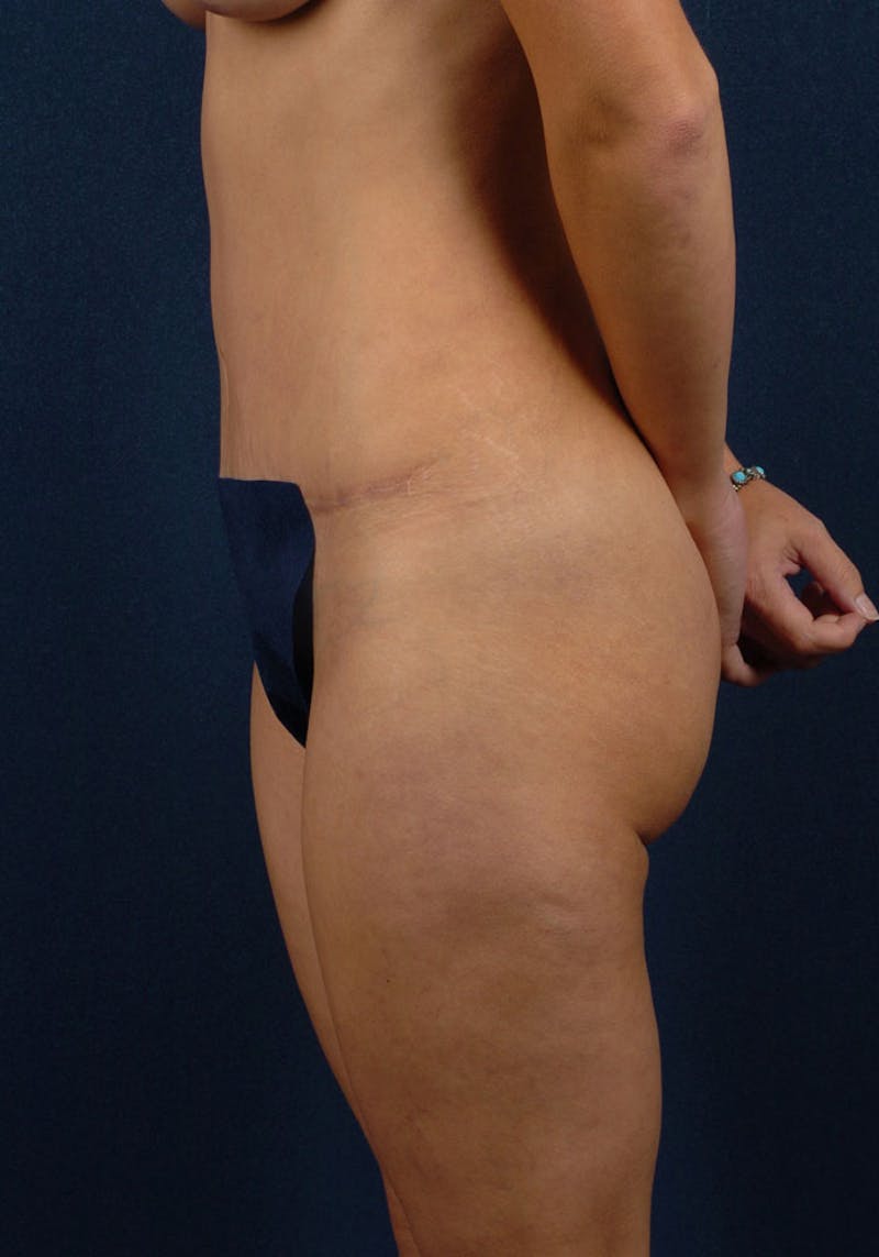 Abdominoplasty Before & After Gallery - Patient 9265410 - Image 6