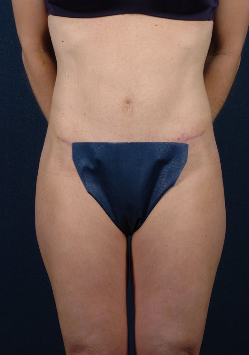 Abdominoplasty Before & After Gallery - Patient 9265438 - Image 2
