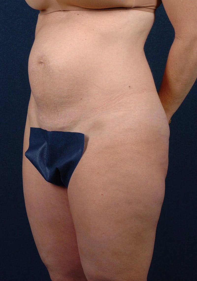 Abdominoplasty Before & After Gallery - Patient 9265438 - Image 3