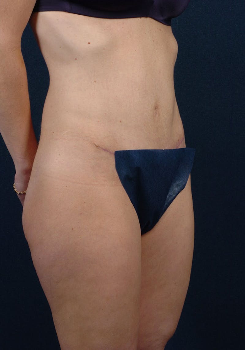 Abdominoplasty Before & After Gallery - Patient 9265438 - Image 6