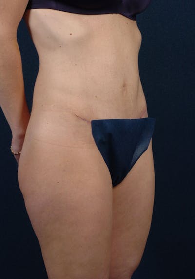 Abdominoplasty Before & After Gallery - Patient 9265438 - Image 6