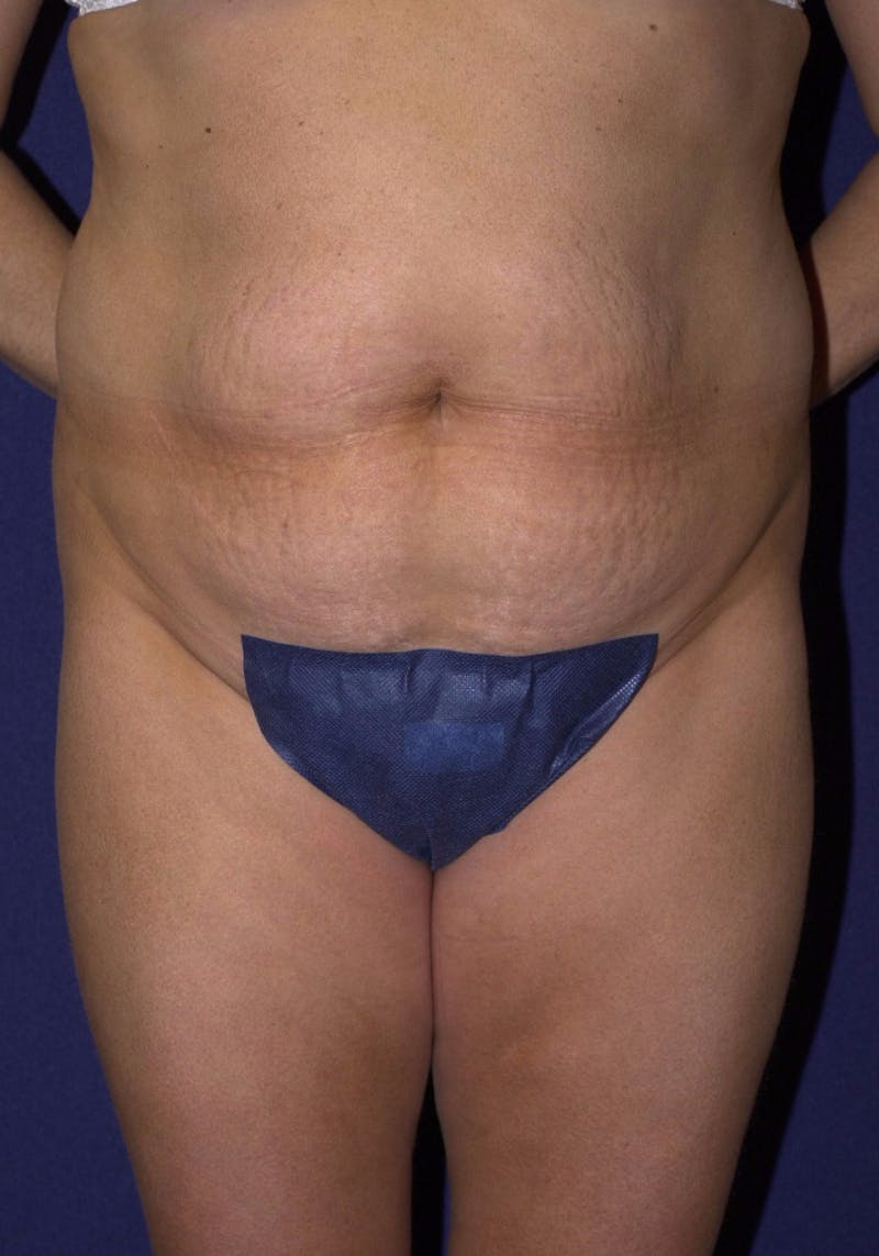 Abdominoplasty Before & After Gallery - Patient 9265552 - Image 1
