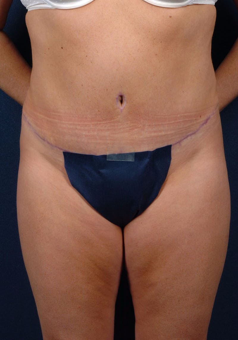 Abdominoplasty Before & After Gallery - Patient 9265552 - Image 2