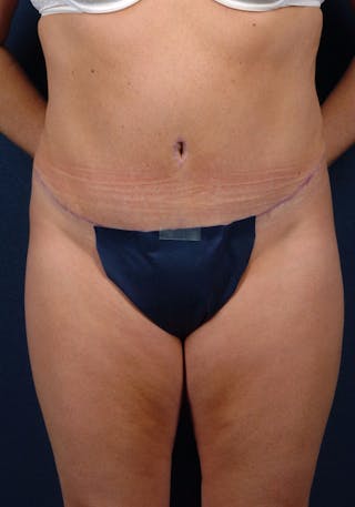 Abdominoplasty Before & After Gallery - Patient 9265552 - Image 2