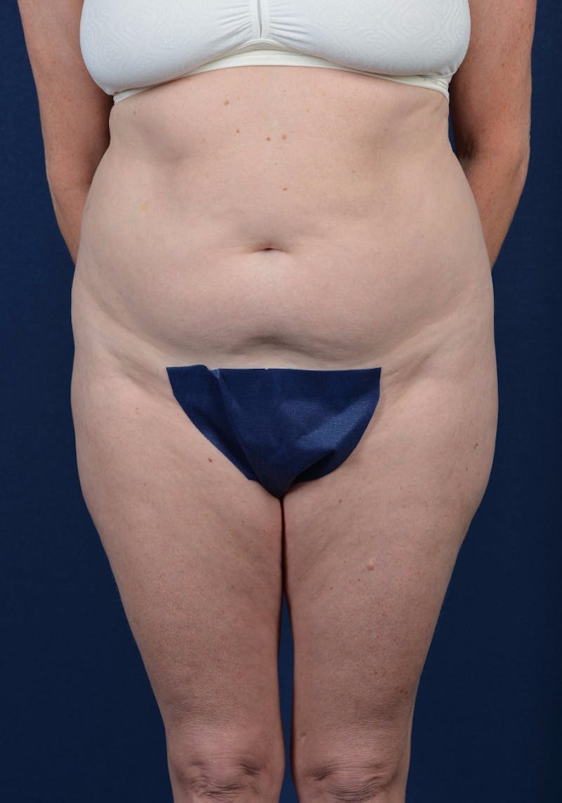 Abdominoplasty Before & After Gallery - Patient 9265557 - Image 1