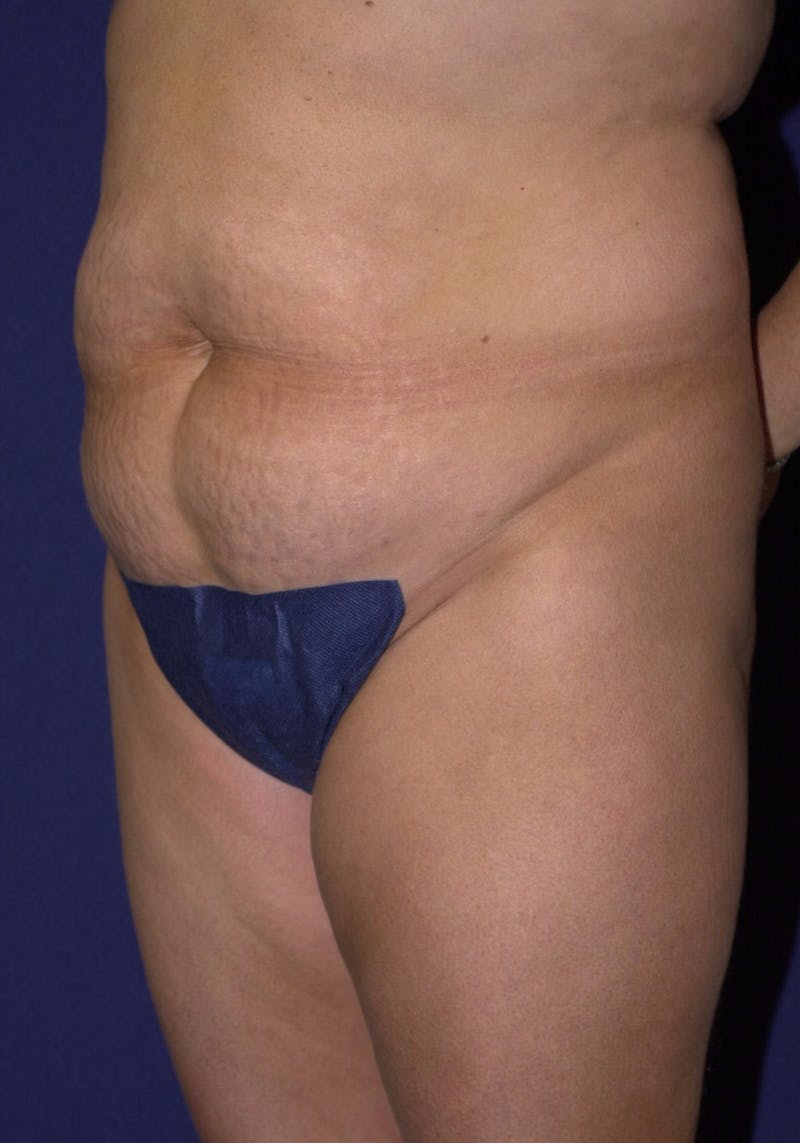 Abdominoplasty Before & After Gallery - Patient 9265552 - Image 3