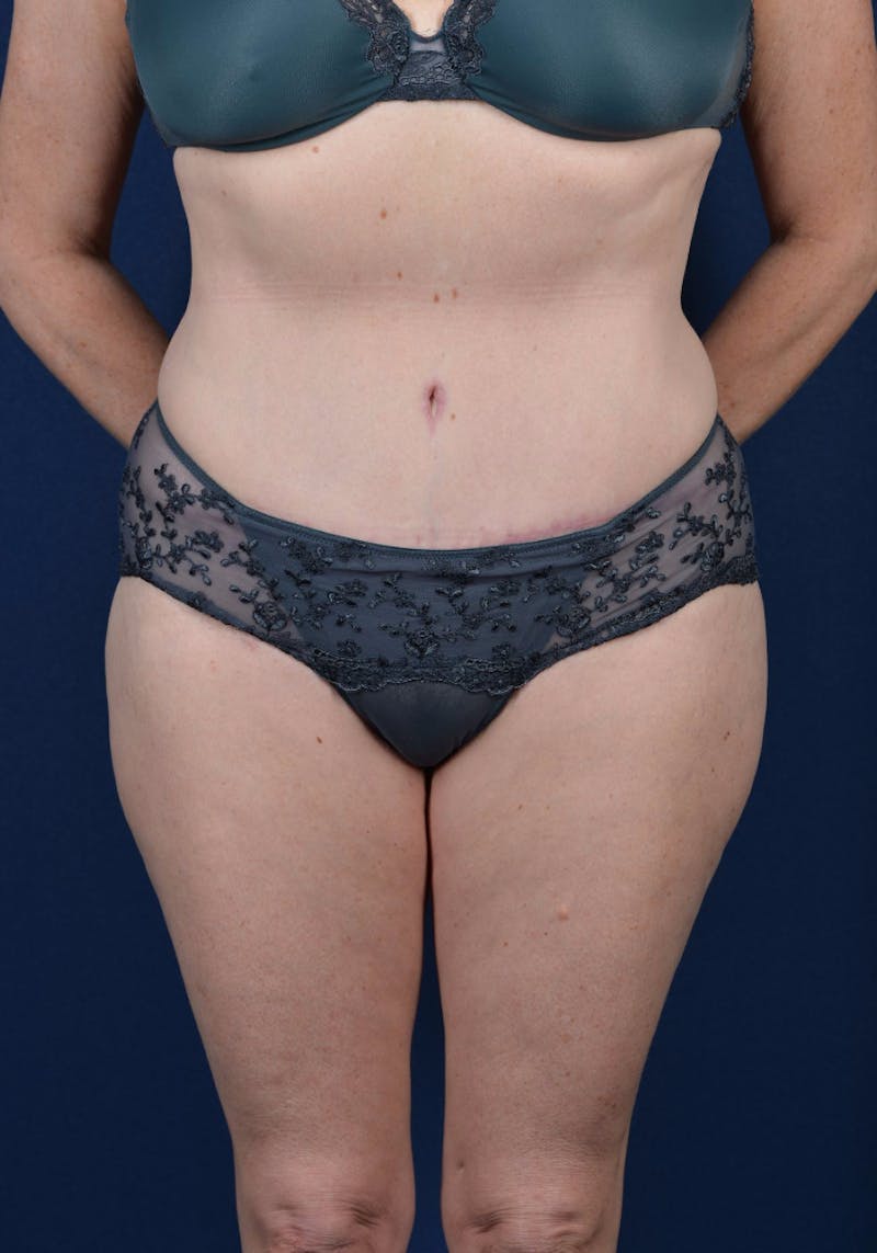 Abdominoplasty Before & After Gallery - Patient 9265557 - Image 2