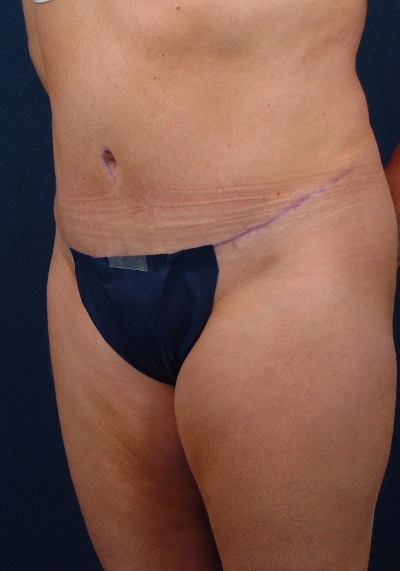 Abdominoplasty Before & After Gallery - Patient 9265552 - Image 4