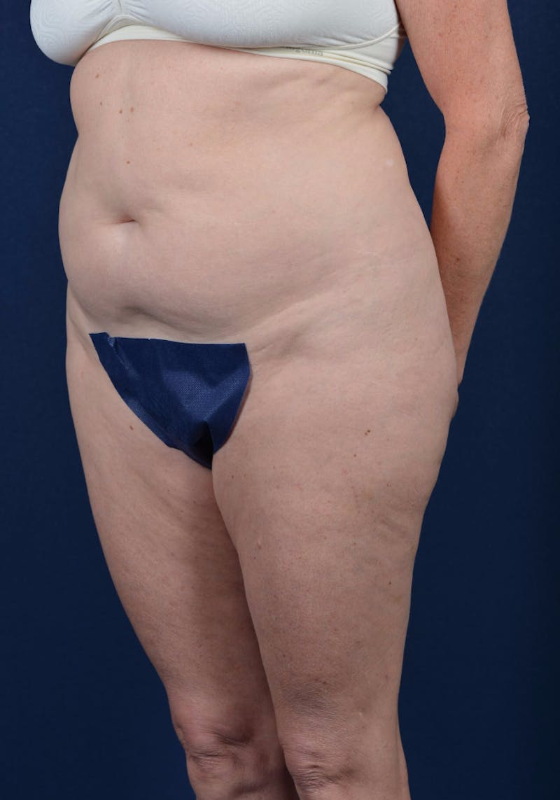 Abdominoplasty Before & After Gallery - Patient 9265557 - Image 3