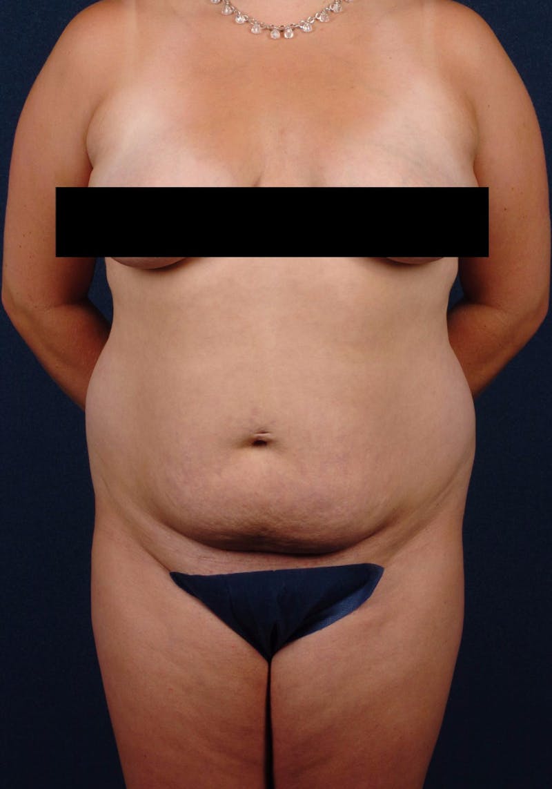 Abdominoplasty Before & After Gallery - Patient 9265561 - Image 1