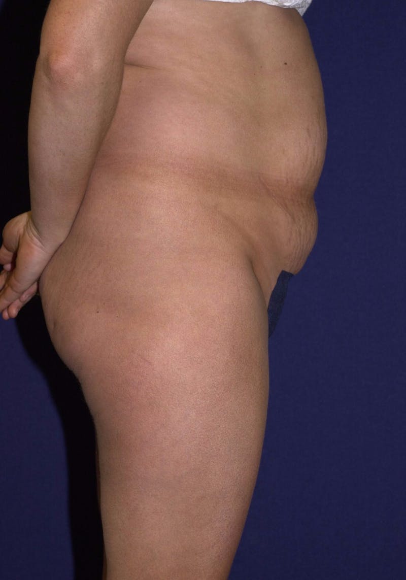 Abdominoplasty Before & After Gallery - Patient 9265552 - Image 5