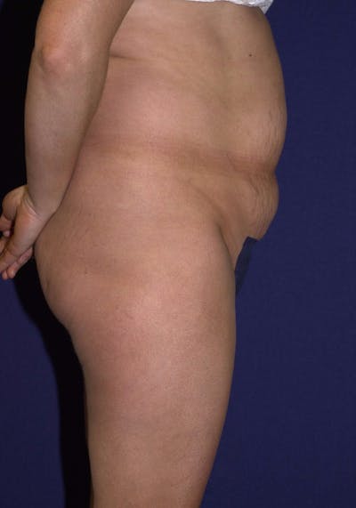 Abdominoplasty Before & After Gallery - Patient 9265552 - Image 5