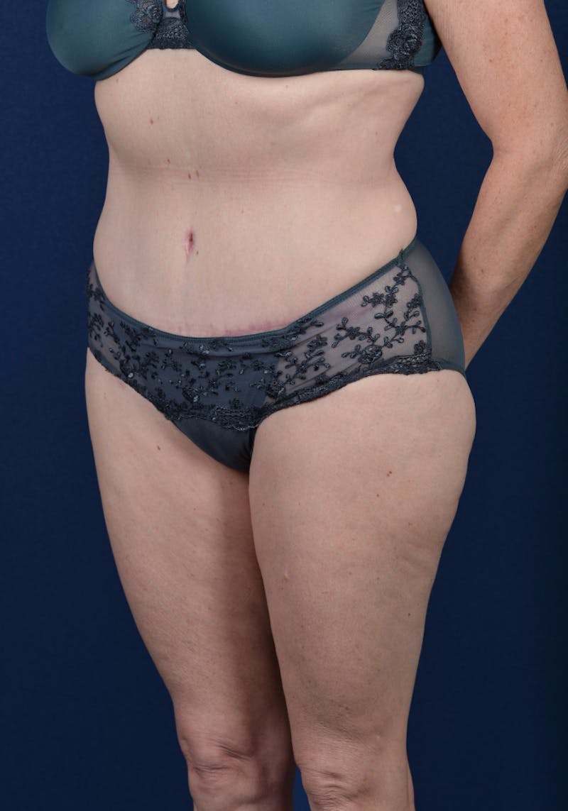 Abdominoplasty Before & After Gallery - Patient 9265557 - Image 4