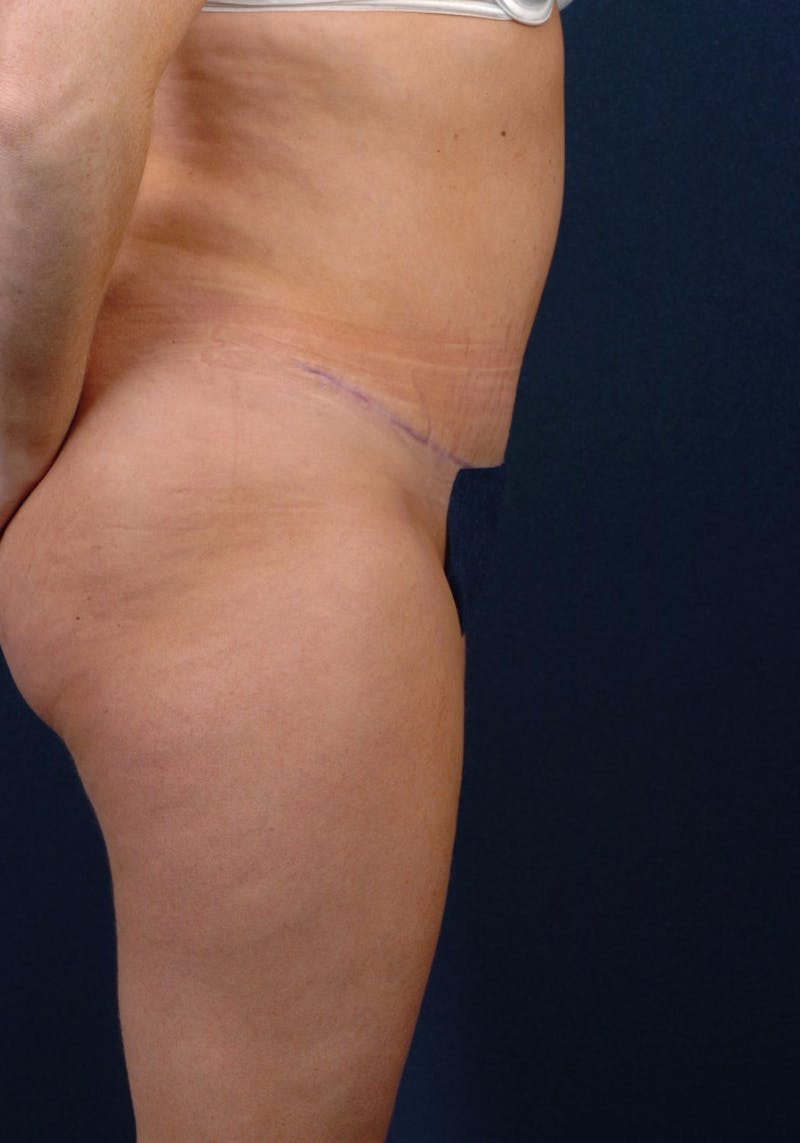 Abdominoplasty Before & After Gallery - Patient 9265552 - Image 6