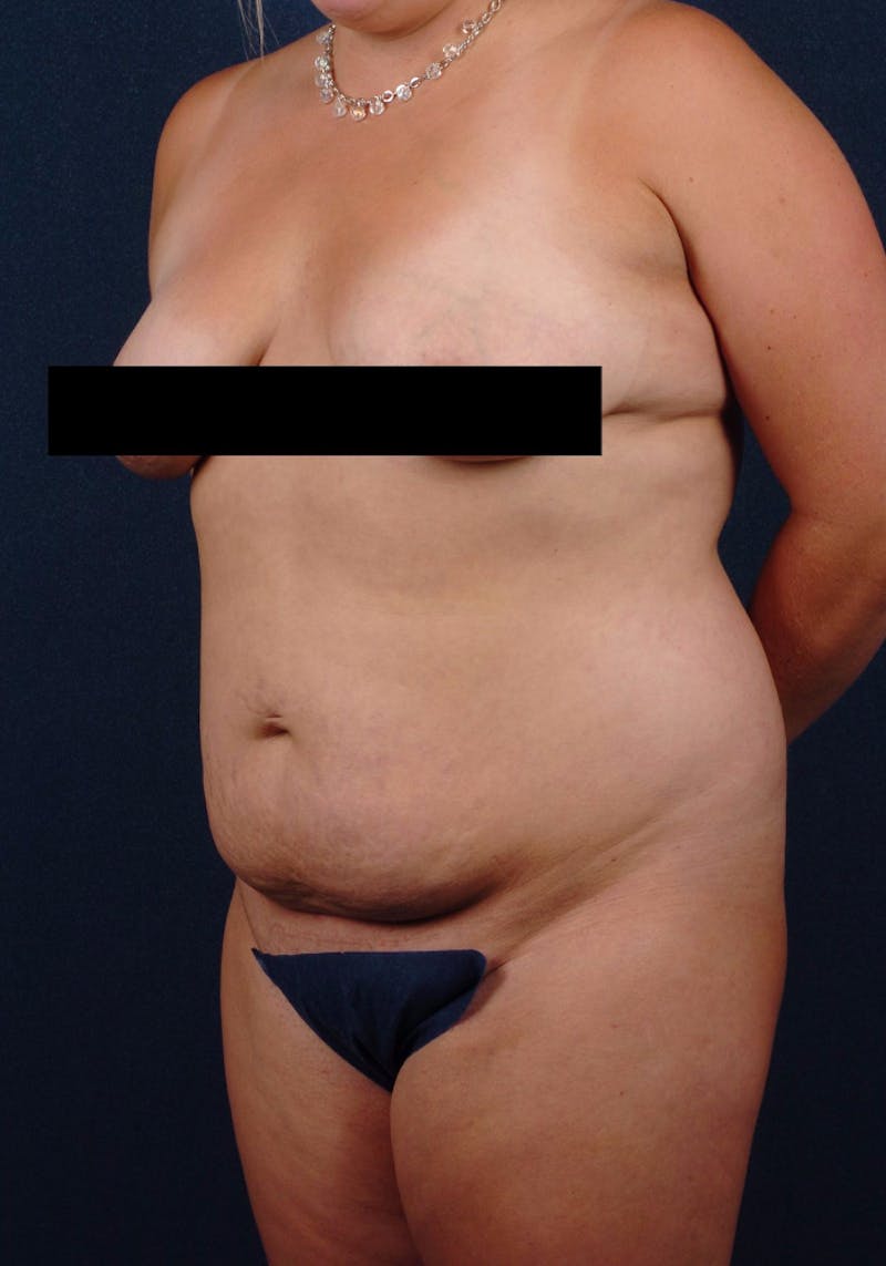 Abdominoplasty Before & After Gallery - Patient 9265561 - Image 3